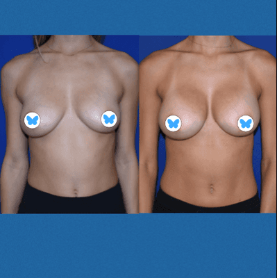 Breast Augmentation