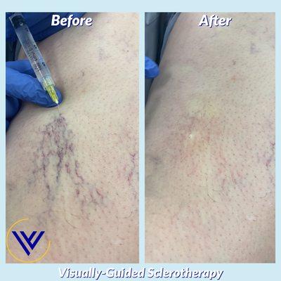 Immediate image before and after spider vein treatment with sclerotherapy at the Center for Varicose Veins - Dr. Vinay Madan, MD, DABVLM