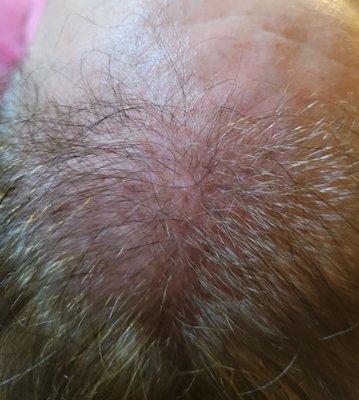 Look I'm actually growing new hair!  I'm so excited!  This was about 2 weeks after my initial treatment!