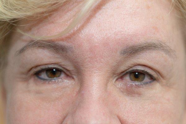 What a difference tattooing inside the wet line can make, covering up the redness, making eyes brighten up. Also soft brow tattoo.