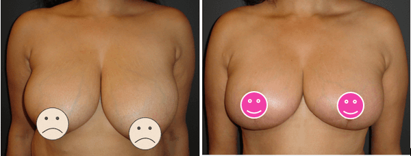 Dr. DeVito Breast Reduction Before and After