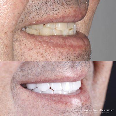 Full mouth smile makeover