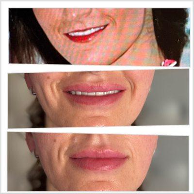 Lip Filler with Restylane Kysse and lip flip with Dysport @ CPMedSpa Laser & Skin. Text 910-347-5444 for more info