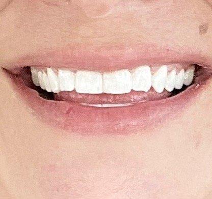 After cleaning & whitening