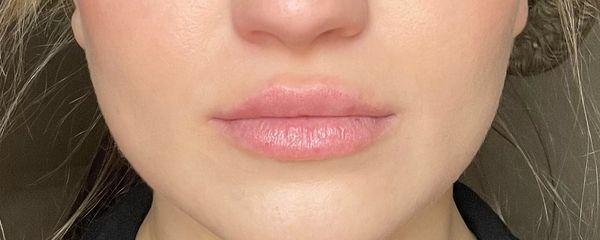 Post 1 syringe of Juvederm Ultra XC