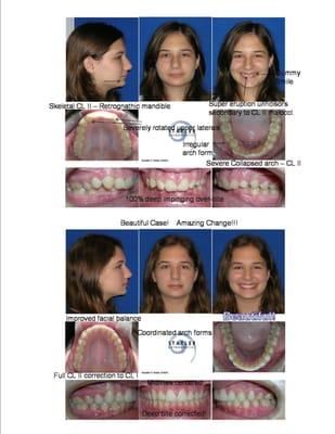 We love challenging cases-  and getting beautiful results!