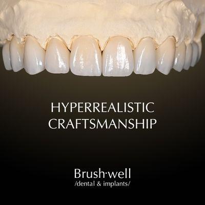 Custom hand-layered ceramic veneers personalize for each patient by our award-winning master ceramist