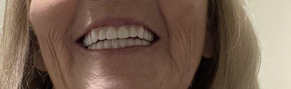 Permanent zirconia implants from ClearChoice Dental Nashville Tennessee