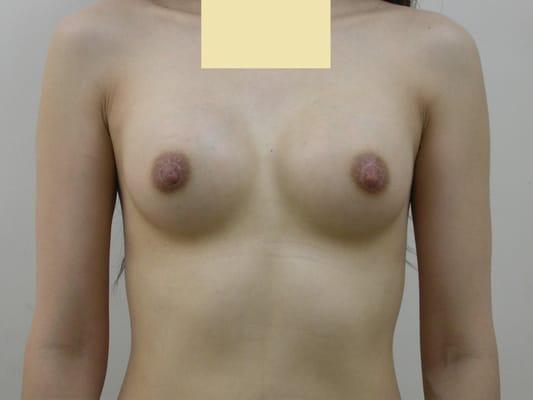 3 months after breast augmentation with nipple lift.