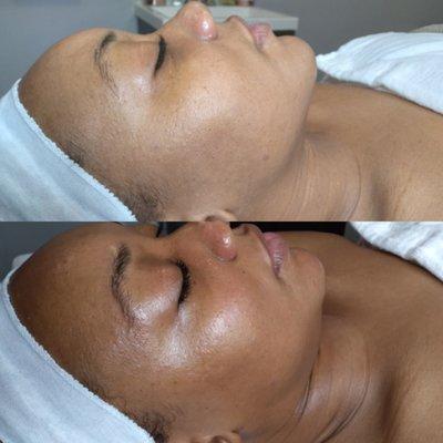 Dermaplaning Facial