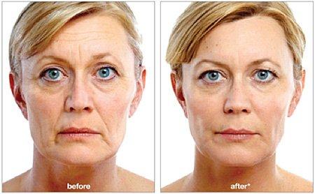 Voluma and Juvederm