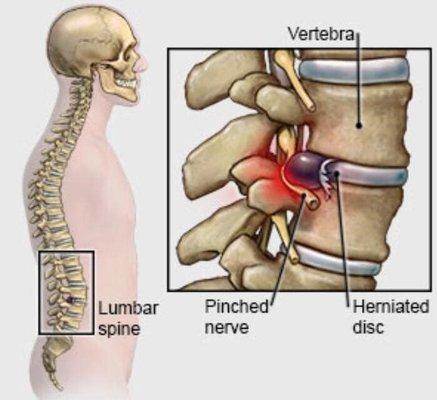 We can help with disc disorders!! There is NO NEED to suffer with pain and limited mobility!