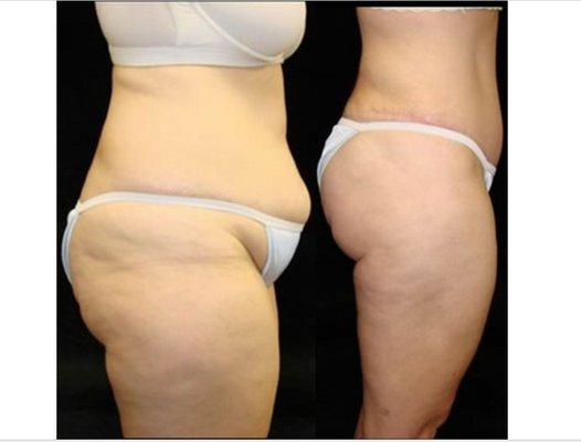 Tummy Tuck