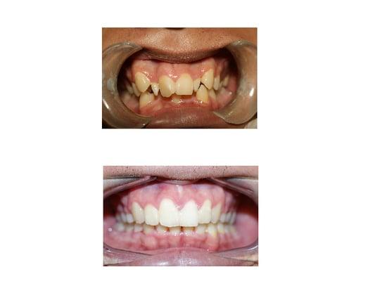 Before and after braces.