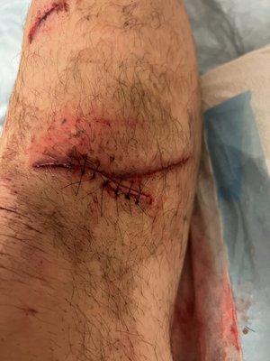 Right shin lacerations