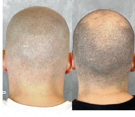 Call us for more information about scalp micro pigmentation! Get your hair fuller, younger looks!