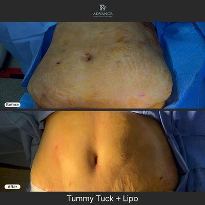 Tummy Tuck