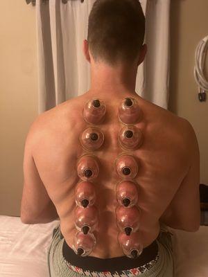 Cupping Therapy