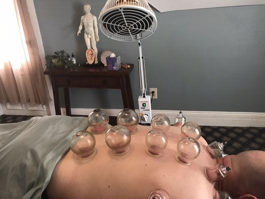 Cupping Therapy is an excellent way to get rid of aches, pains and detox the body.