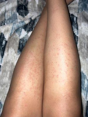 Possible infection from leg scrub??