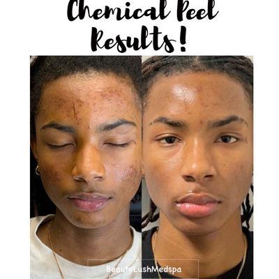 Chemical Peel for acne & discoloration