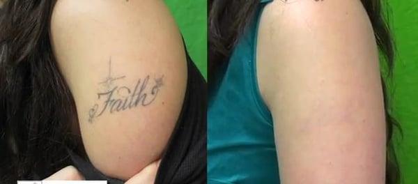 Laser Tattoo Removal