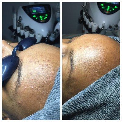 Before and after ! After only one face treatment