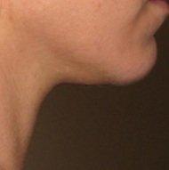 My after! I no longer see the double chin in the mirror. I also have definition on my jawline.