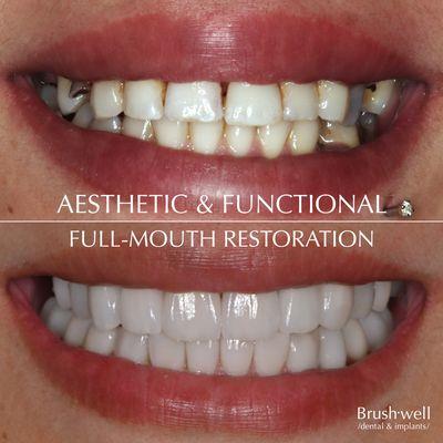 Full Mouth Rehab - Veneers, Crowns, and Implants