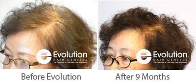 Women's Hair Loss Treatment Results at Evolution Hair Centers