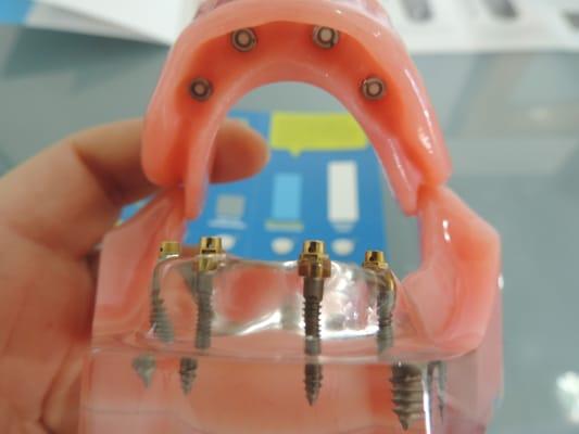 Zimmer Mini Denture Implants.