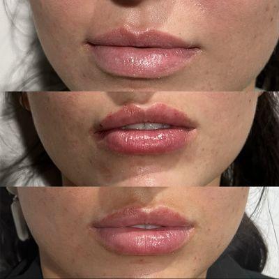 Versa Lip Filler Results 

#abilenetotalwellness