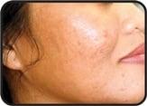 Post Acne Scarring Treatment