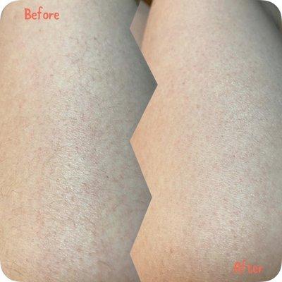 Before and after body sugar hair removal