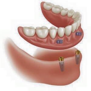 Implant Retained Lower Denture