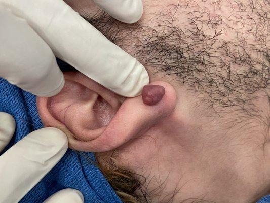 Keloid before my removal surgery