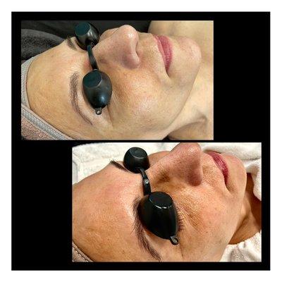 Before picture (bottom). Top picture is after clean & custom with Dermaplanning.