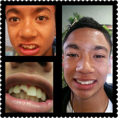 Dr. Yu filled my son's broken tooth and it looks like a real tooth! My son is no longer ashamed to smile.