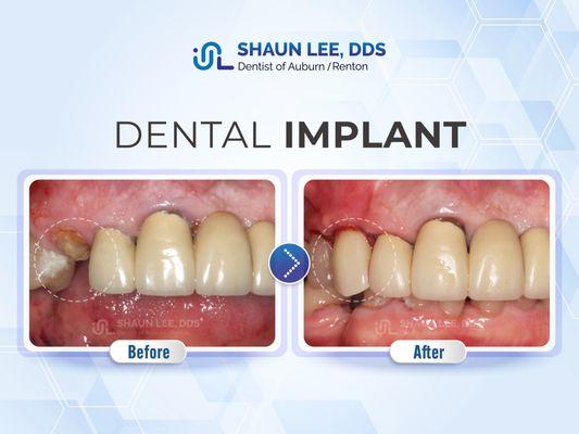 Shaun Lee, DDS Family Emergency Dental Implants of Renton | 10700 SE 174th Street, Suite 204, Renton, WA