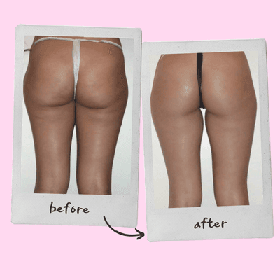 Lipo Sculpt + Ultrasonic Cavitation + Therma Lift