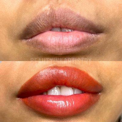 Lip neutralization and scar coverup