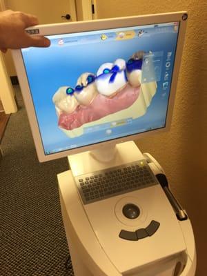 Dr Crockett has lots of experience with CEREC "same day crowns". Whole crown from start to finish in one visit!