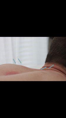 This is an Acupuncture treatment for a lingering cough after a recent illness.