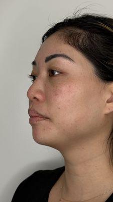 Before - chin filler