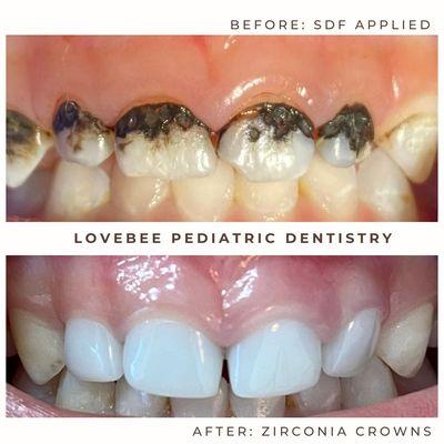 Zirconia Crowns