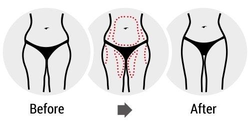 Body Sculpting process reducing fat on target areas.