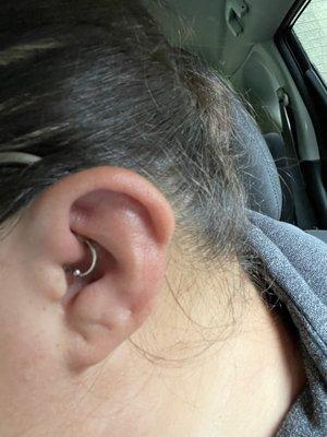 Swelling Prior to Removal Left Ear