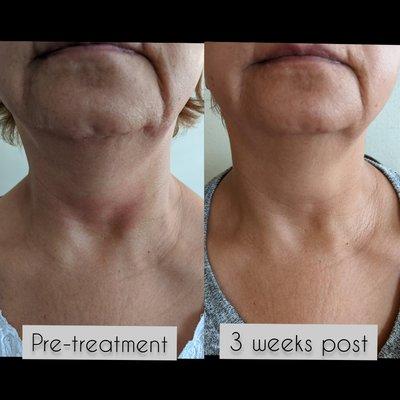 3weeks neck left progress