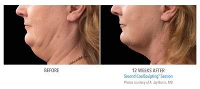 CoolSculpting before and after