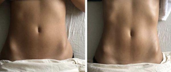 Before and after Lymphatic drainage